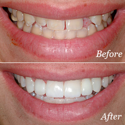 Before and After