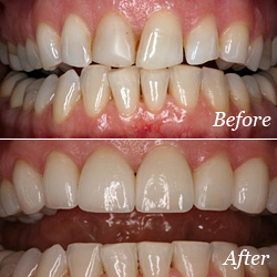 Before and After