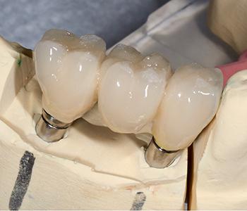 Implant Crowns Gambrills Bingham - Lester Dentistry