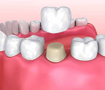 Dr. Bingham-Lester Vickii at Bingham-Lester Dentistry offers affordable same day dental crowns.