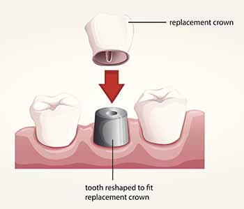 Dental crowns are a dental restoration used when a tooth is badly damaged or decayed, past the point that a filling or cosmetic bonding can repair it