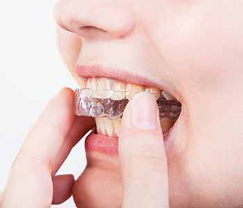 Invisalign is a discreet alternative to metal braces, available from Bingham-Lester Dentistry in Gambrills, MD.