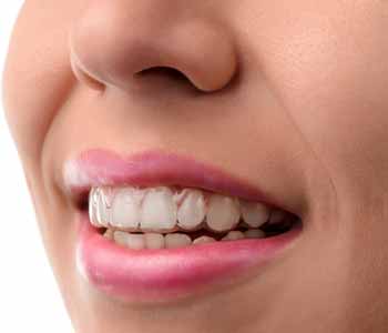 At Bingham-Lester Dentistry, provide Invisalign treatment for patients around Crofton and Gambrills, MD.