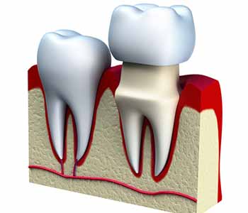 At Bingham-Lester Dentistry, we provide same day dental crowns or CEREC crowns for patients around Crofton and Gambrills, MD.