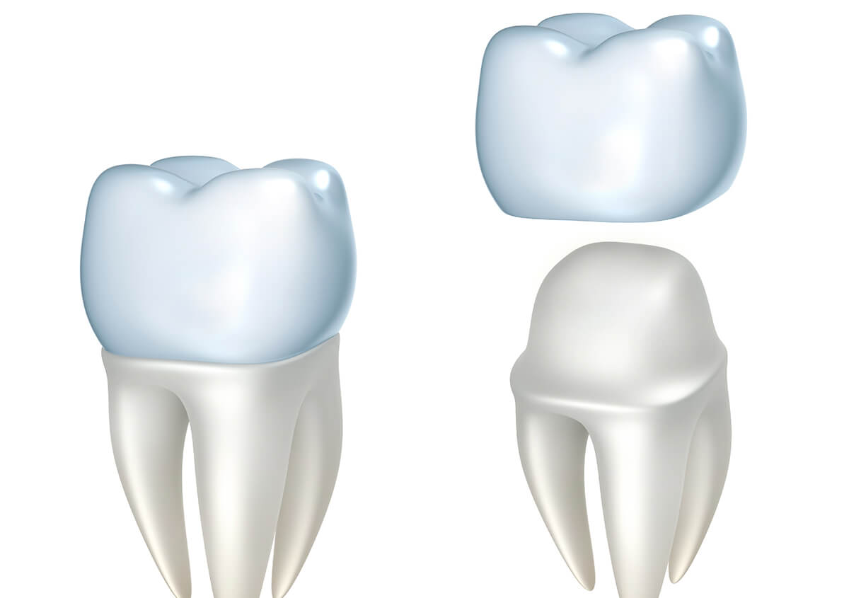 Crowns for Teeth in Crofton MD Area