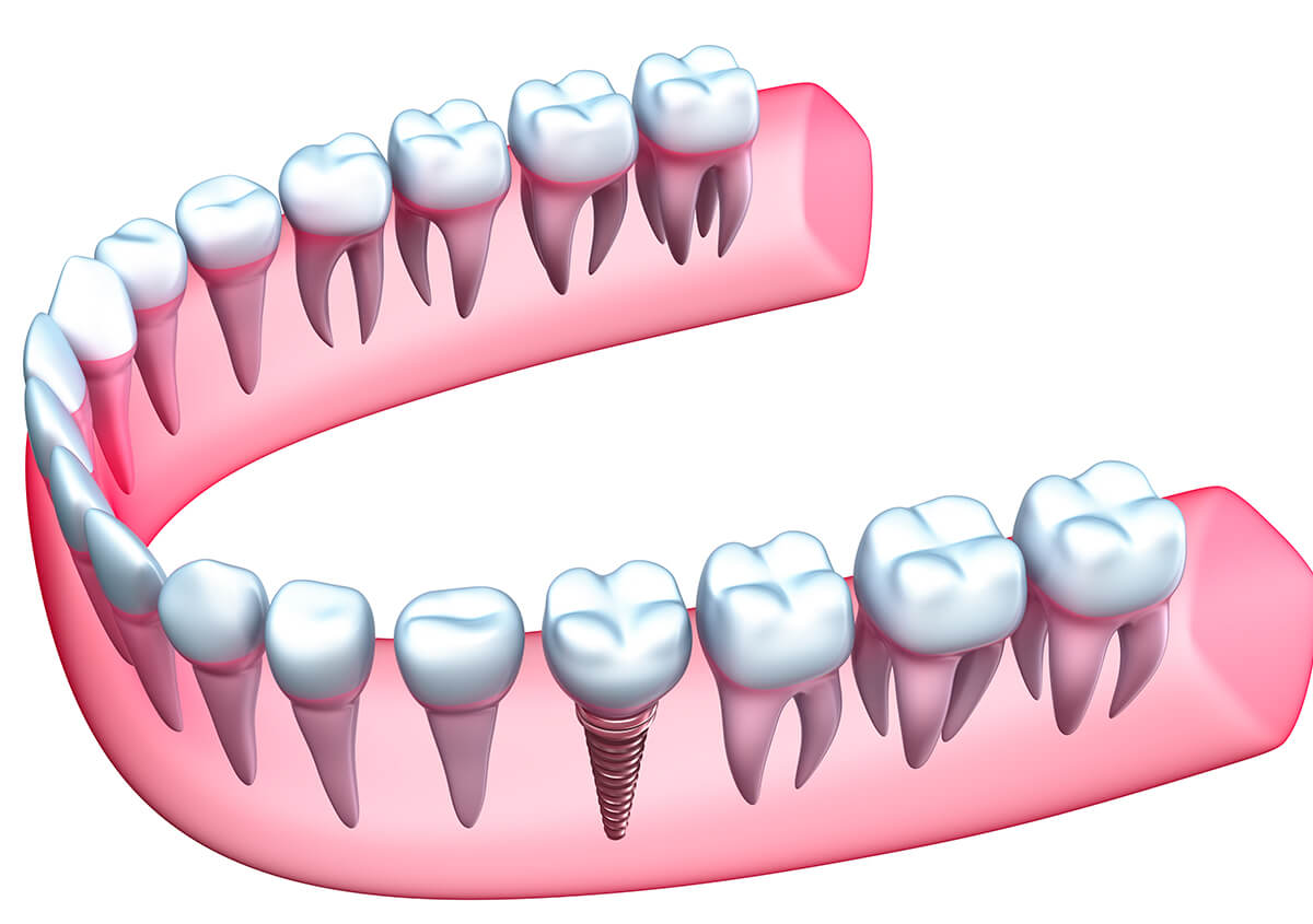 Dental Implant Process in Crofton Maryland Area
