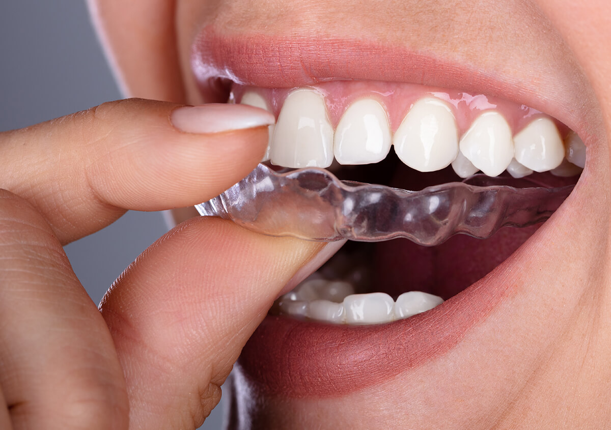 Invisalign Dentist in Gambrills MD Area