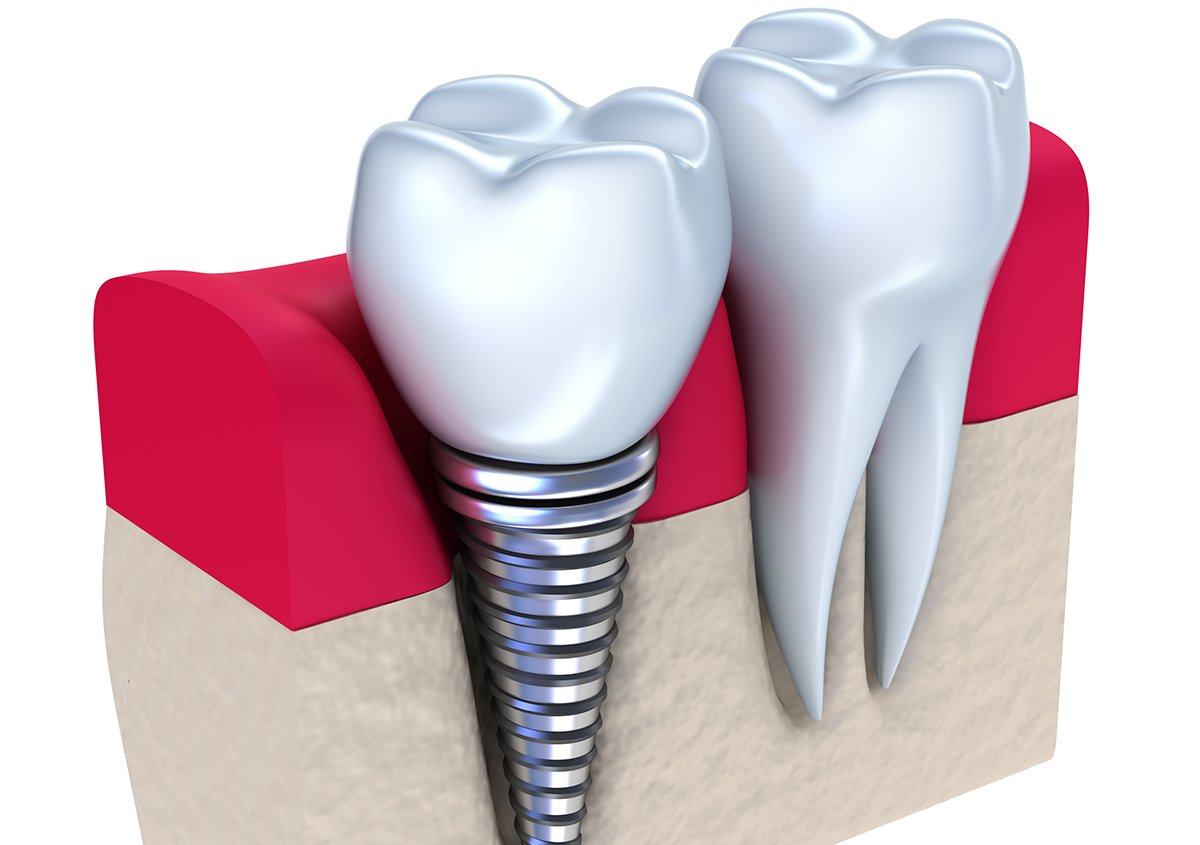 Dieta para implantes dentales