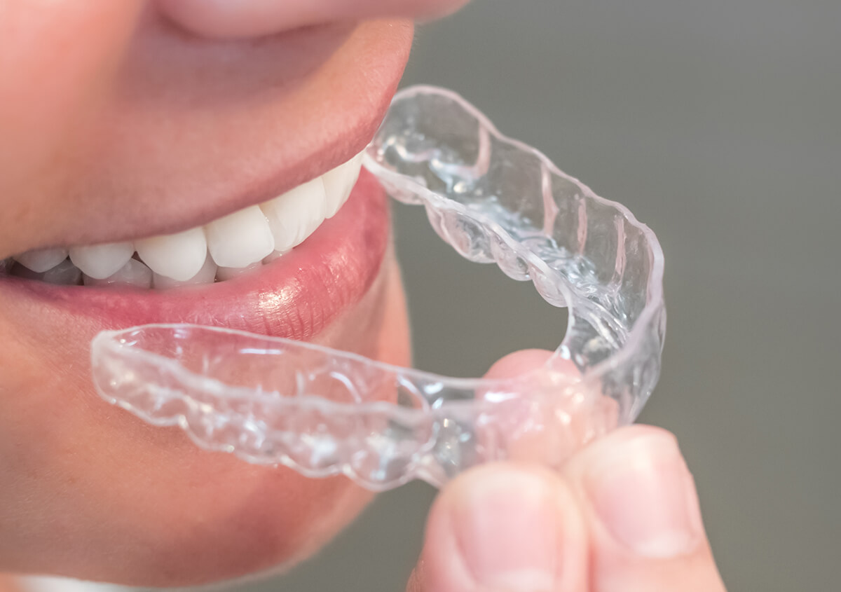 Invisalign Orthodontic Treatment in Gambrills MD Area