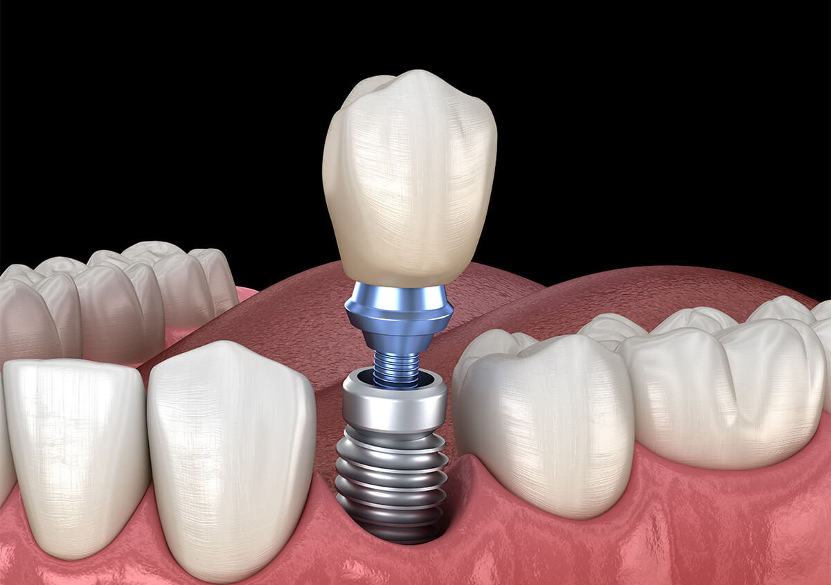 Dental Implants in Crofton MD Area