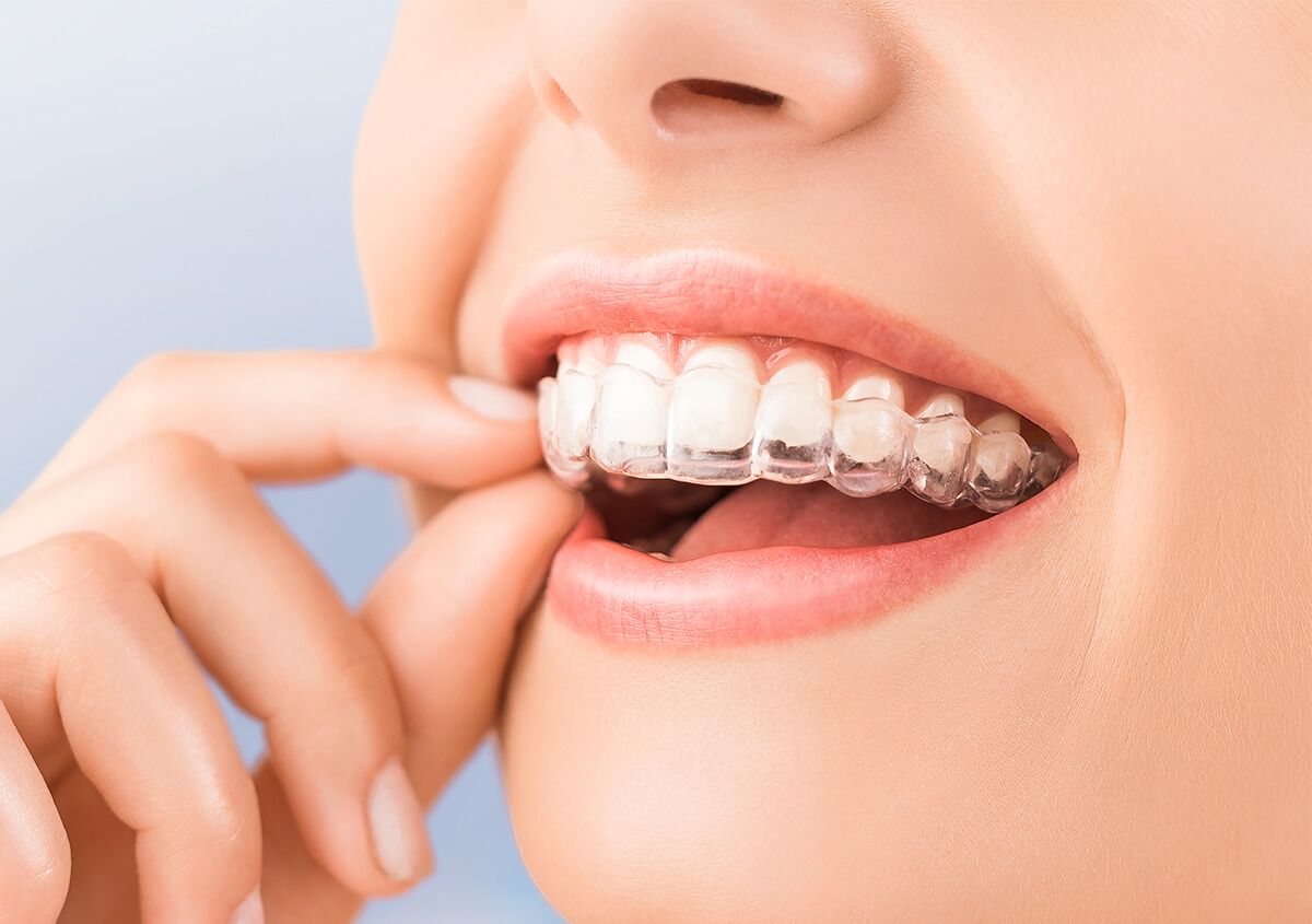 Invisalign Transparent Braces in Crofton MD Area