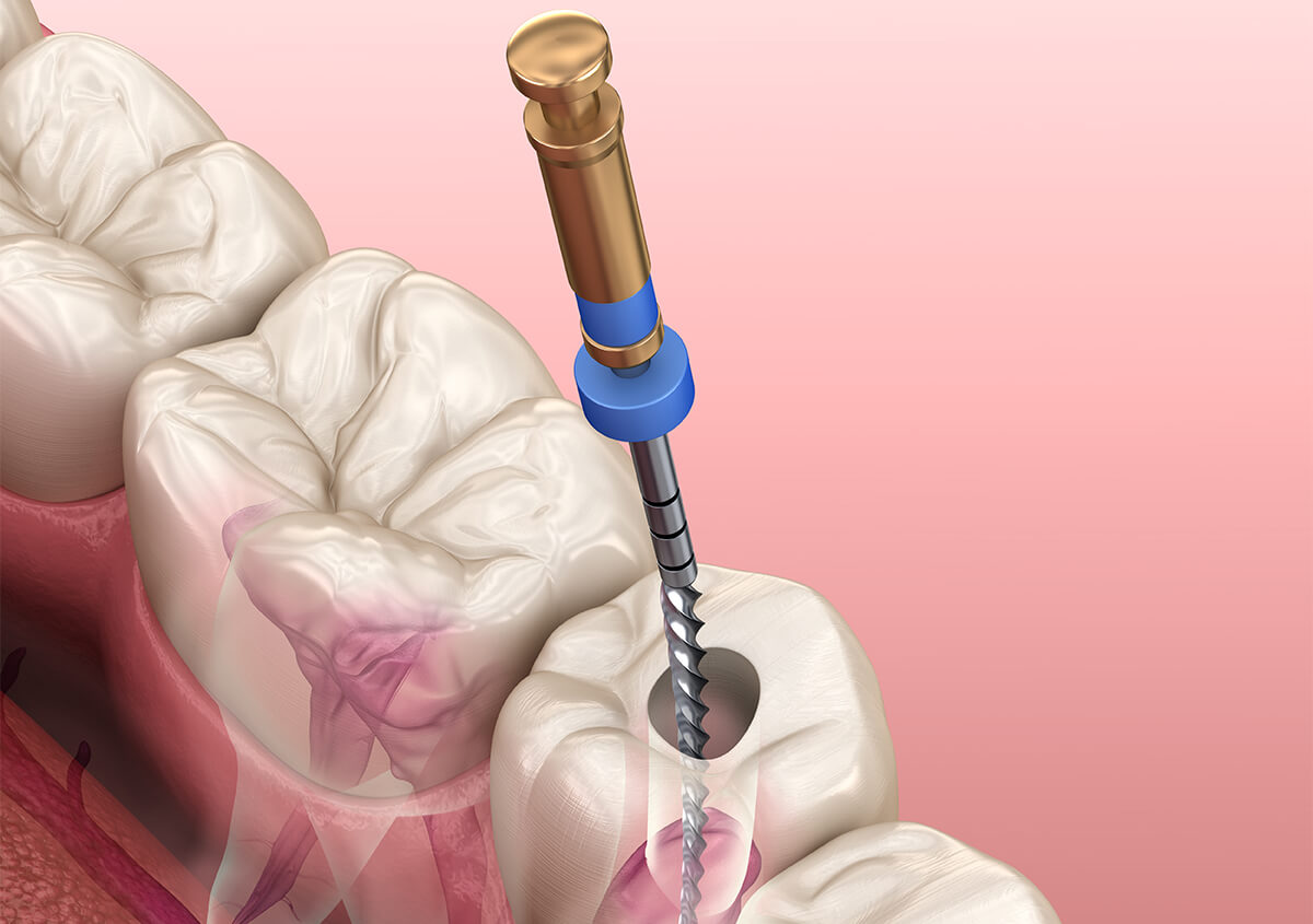 Emergency Root Canal Treatment in Crofton MD Area