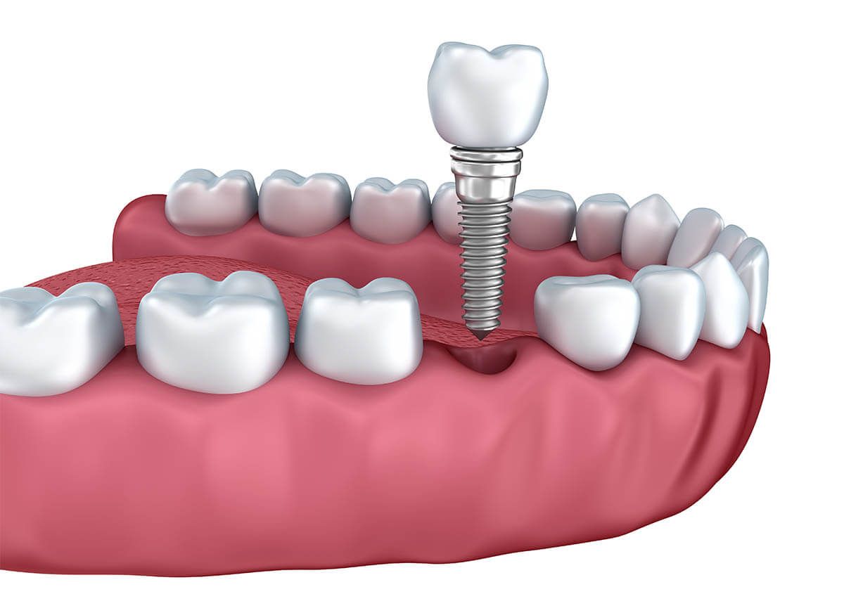 Dental Implant Placement in Crofton MD Area