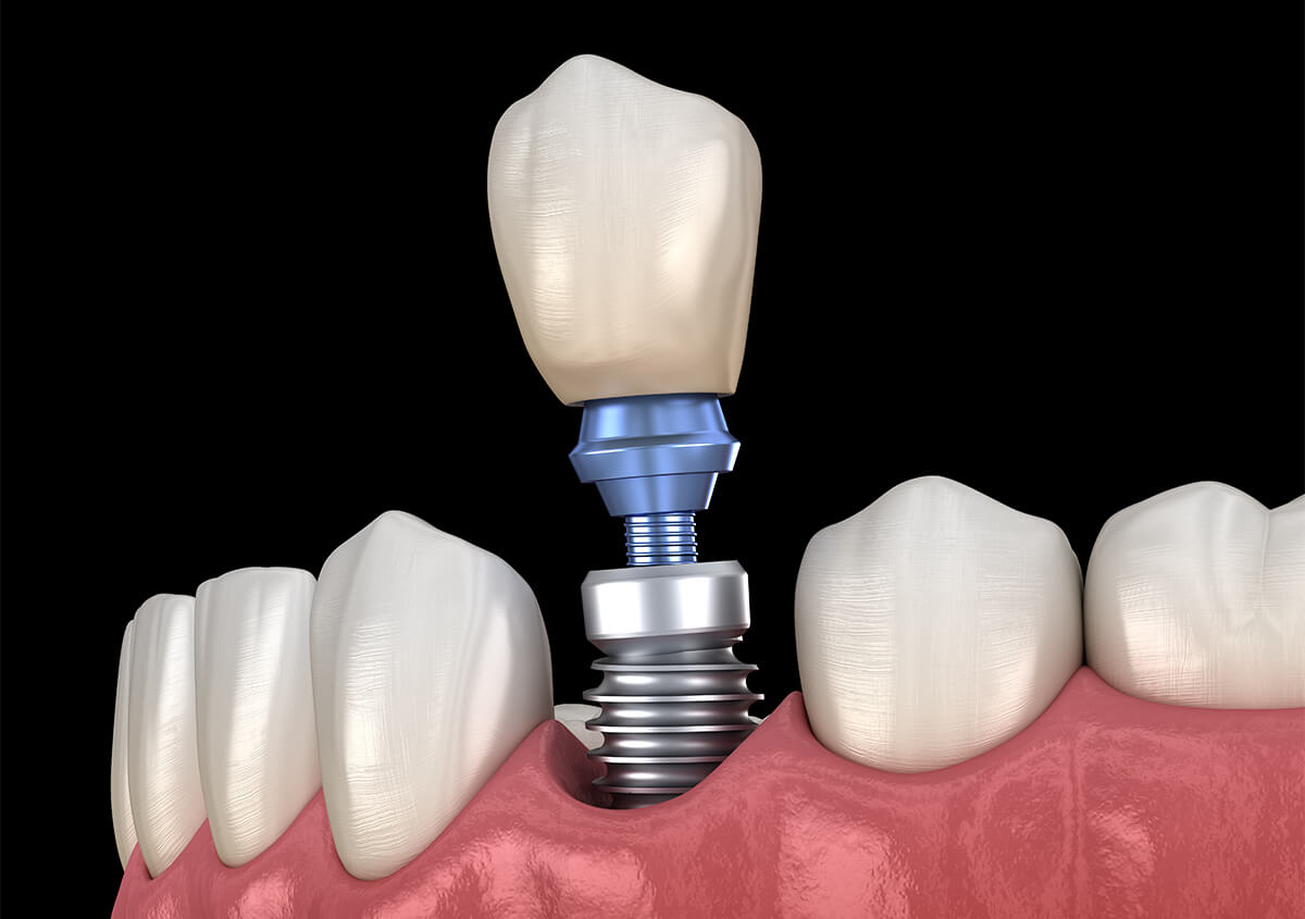 Dental Implant Replacement Service in Crofton Area