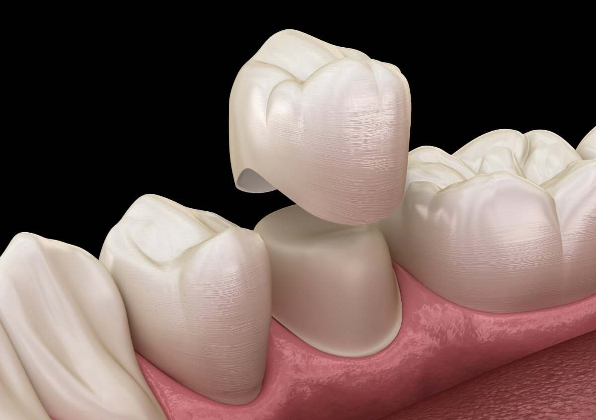 Dental Implant Crowns in Crofton MD area