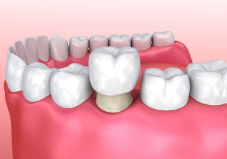 Crown Treatment Cost in Annapolis MD
