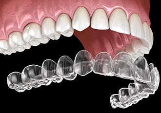 Invisalign Treatment in Annapolis MD Area