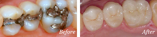 Dental Fillings Before After Results