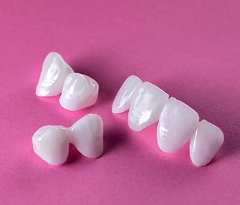 A dental bridge spans the gap left by one or several adjacent missing teeth.