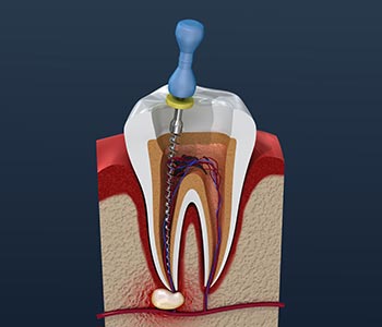 Read More About Endodontic Treatment