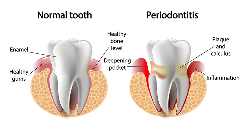 Gum disease is measured by the attachment of gums to teeth.