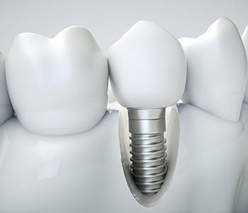 Dental implants in Gambrills mimic a tooth root, providing a strong, stable foundation for a porcelain crown.