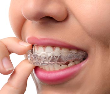 Dr. Bingham-Lester uses Invisalign® for situations from mild crowding or spacing issues to complex cases.