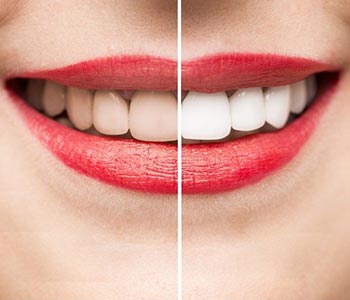 Vickii R. Bingham-Lester, DMD recommends KöR® teeth whitening to Gambrills patients in the Crofton, MD area, for three simple reasons. KöR® is effective, comfortable, and permanent.