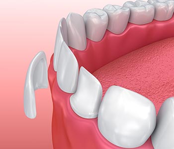 Dental veneers in Gambrills are not replacement teeth, but are considered to be prosthetics – artificial body parts.